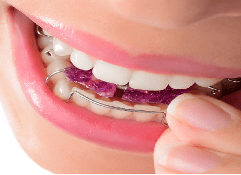 ارتودنسی بهتره یا کامپوزیت,ارتودنسی دندان,بعد ارتودنسی