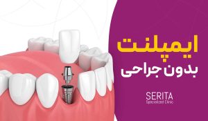 کاشت ایمپلنت دندان بدون جراحی چگونه انجام می‌شود؟