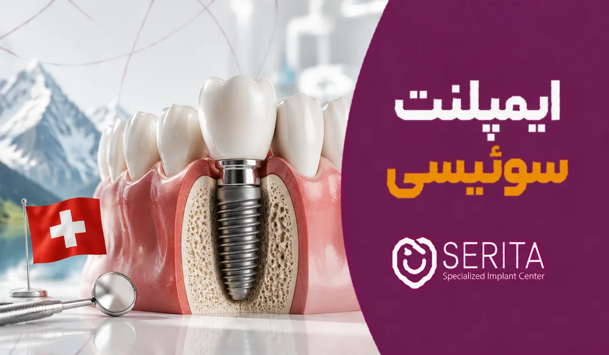 ایمپلنت سوئیسی | بررسی بهترین برندها، قیمت و طول عمر