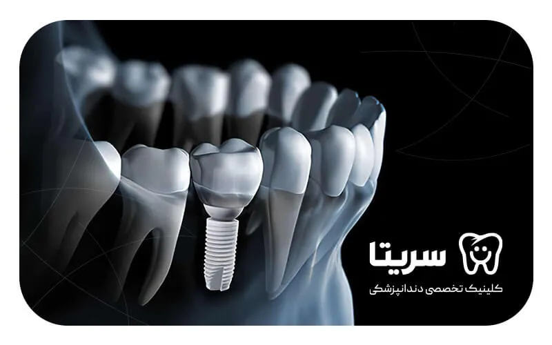 ایمپلنت زیرکونیا داخل استخوان فک