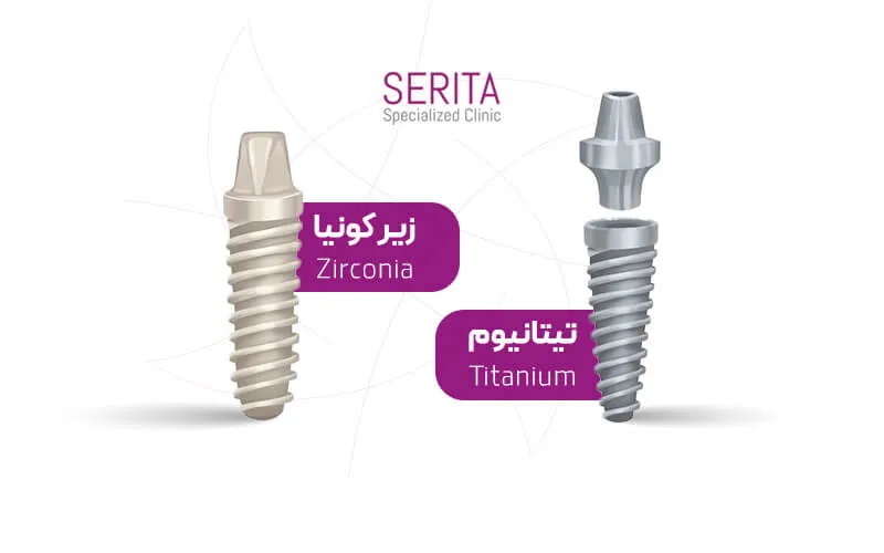 در سمت چپ ایمپلنت زیرکونیا و در سمت راست ایمپلنت تیتانیوم