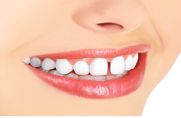 دندان های فاصله دار با ارتودنسی درمان می شود