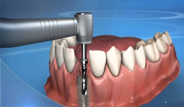 بعد از ایمپلنت,جایگزینی دندان,روش جدید ایمپلنت
