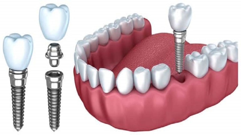 ایمپلنت سوئیسی از باکیفیت ترین برندهای ایمپلنت دندان است