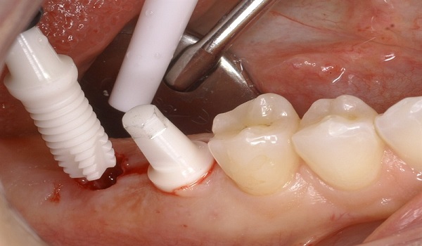 انواع ایمپلنت دندان,ایمپلنت دندان,جایگزینی دندان