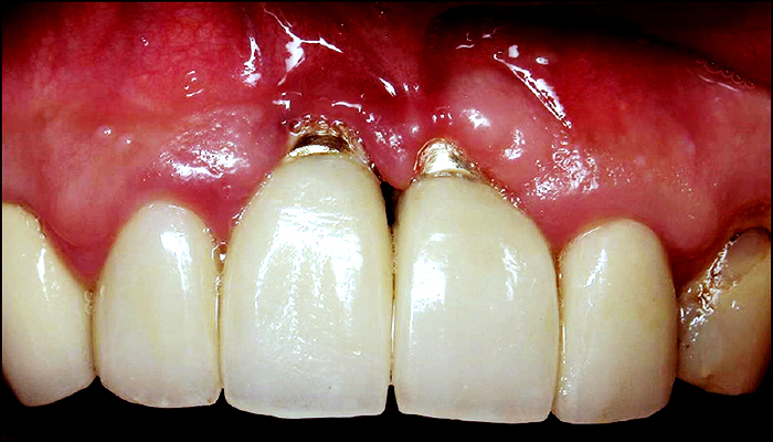 جایگزینی دندان,روش جدید ایمپلنت,کاشت دندان