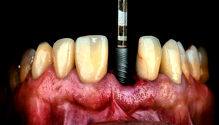 انواع ایمپلنت دندان,ایمپلنت دندان,بعد از ایمپلنت