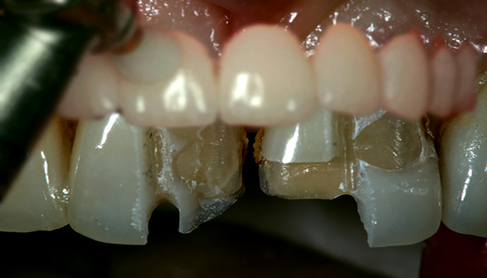 آیا لمینت دندان ها ضرر دارد؟