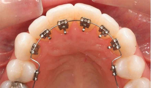 ارتودنسی دندان,بعد ارتودنسی,بهترین نوع ارتودنسی دندان