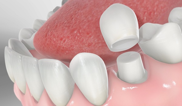 روکش دندان راهی برای محافظت از دندان آسیب دیده.