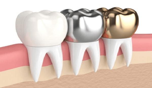 دندان متحرک یا ایمپلنت,رفع سیاهی دندان,روکش دندان