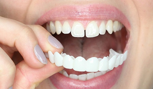 انواع لمینت دندان,رفع سیاهی دندان,روکش دندان