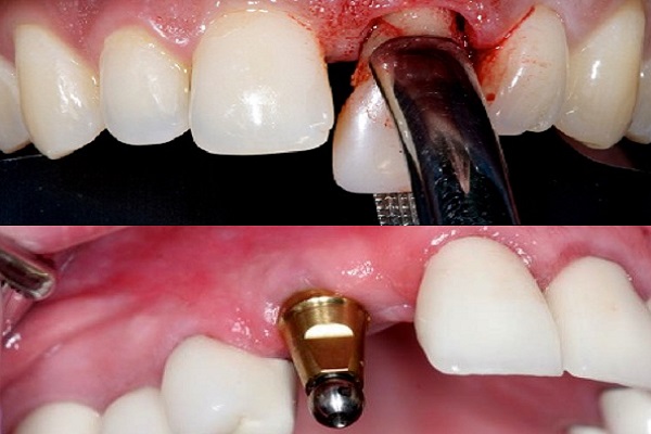 انواع ایمپلنت دندان,ایمپلنت دندان,بعد از ایمپلنت