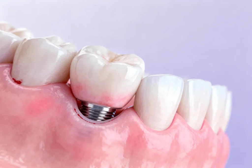 خونریزی اطراف ایمپلنت، از علائم لق شدن ایمپلنت دندان است.