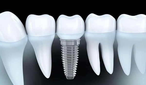 یکی از روش های کاشت دندان، ایمپلنت است