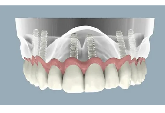 ایمپنلت تیتانیوم یا زیرکونیا در ایمپلنت دندان جلو