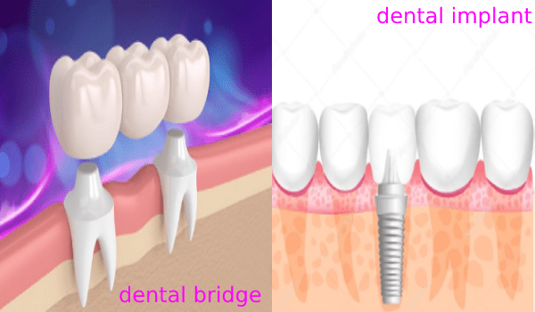 بریج دندان و ایمپلنت دندان