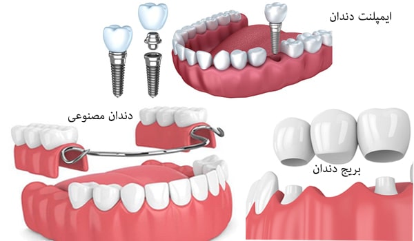 روش های جایگزینی دندان: ایمپلنت-دندان مصنوعی-بریج دندان