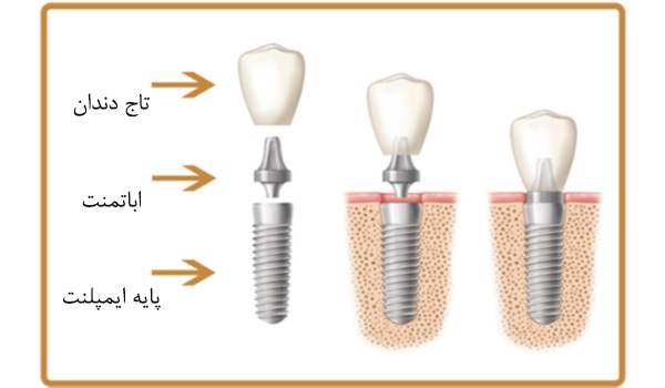ایمپلنت دندان ساختاری سه بخشی دارد.