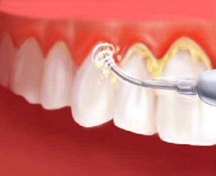 عدم رعایت بهداشت، می تواند باعث بروز عفونت ایمپلنت دندان شود.