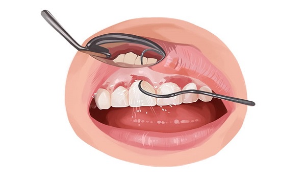 یکی از مشکلات ایمپلنت دندان، عفونت آن است