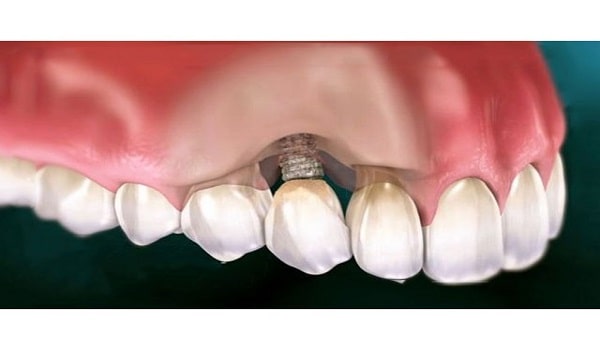 رایج ترین بیماری لثه در ایمپلنت دندان، پری ایمپلنتایتس است