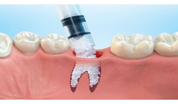 یکی از کاربردهای پیوند استخوان در ایمپلنت دندان است