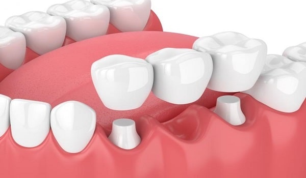 بریج یکی از روش های کاشت دندان بدون ایمپلنت است