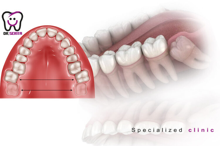 wisdom-tooth