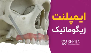 ="ایمپلنت