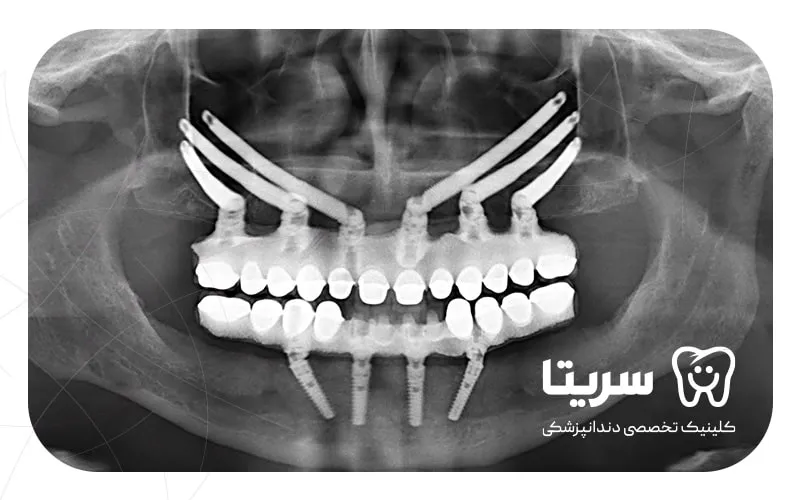 عکس سی تی اسکن ایمپلنت زیگوماتیک
