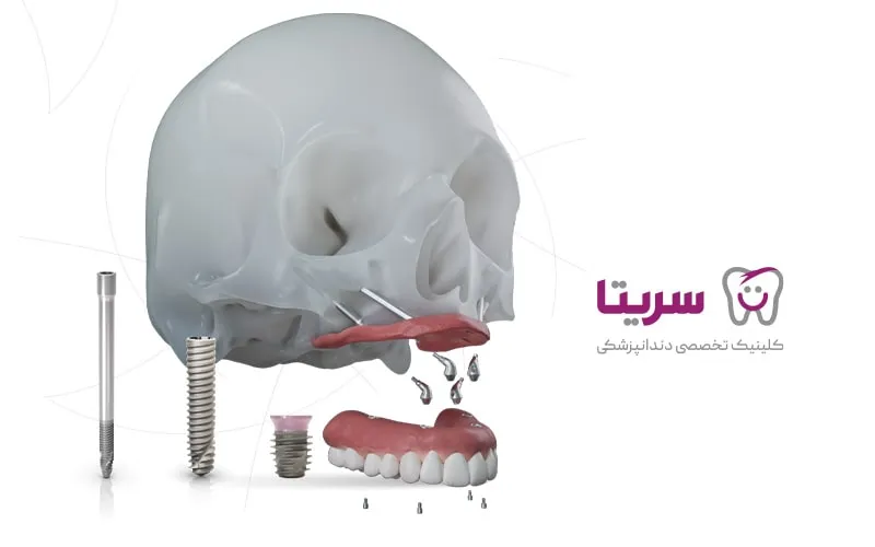 ایمپلنت زیگوماتیک برای فک بالا کاربرد دارد.