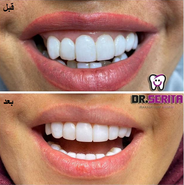 نمونه ارتودنسی دندان دکتر سریتا