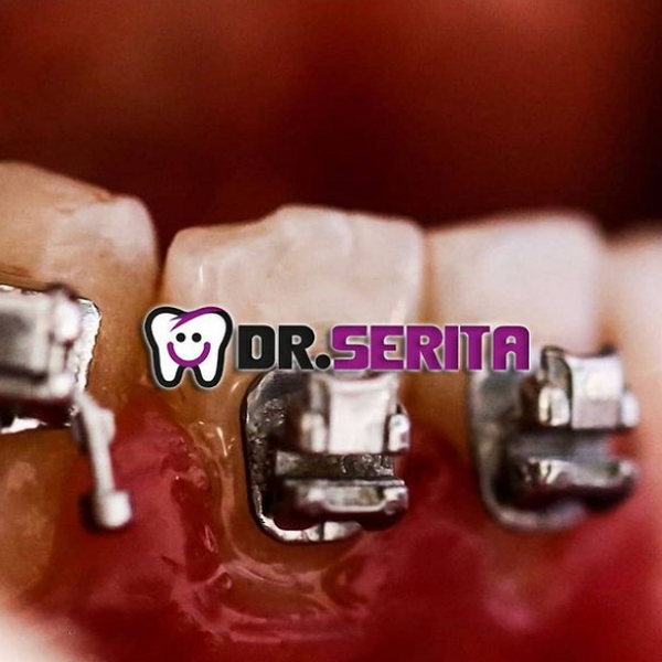 نمونه ارتودنسی دندان دکتر سریتا