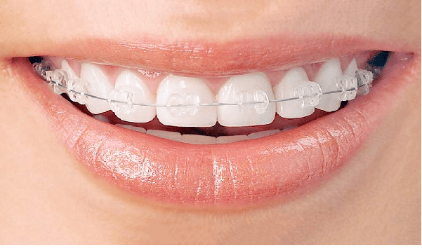 ارتودنسی سرامیکی، یکی از انواع ارتودنسی دندان