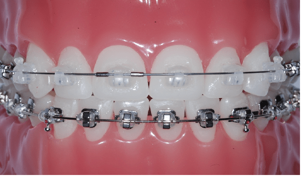 ارتودنسی دیمون، یکی از انواع ارتودنسی دندان