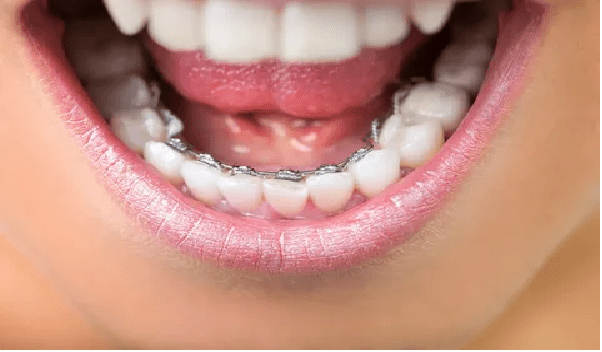 ارتودنسی لینگوال یا پشت دندانی از انواع ارتودنسی دندان