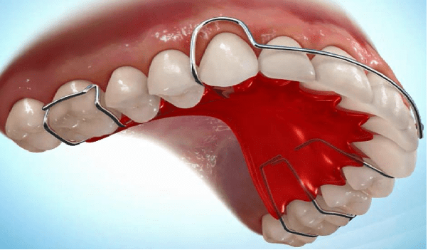 ارتودنسی متحرک، از انواع ارتودنسی دندان