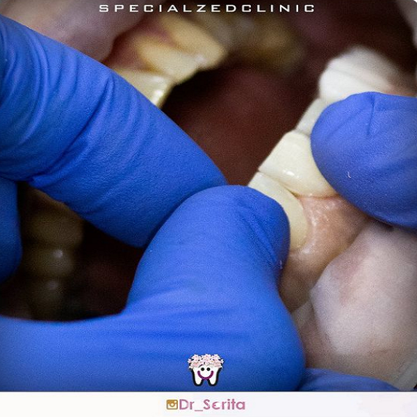 نمونه ایمپلنت دندان دکتر سریتا