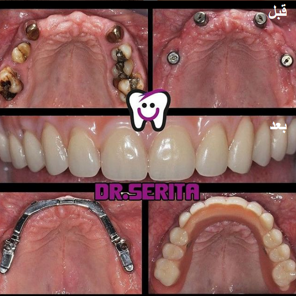 نمونه ایمپلنت دندان دکتر سریتا