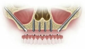 ایمپلنت دندان زیگوماتیک