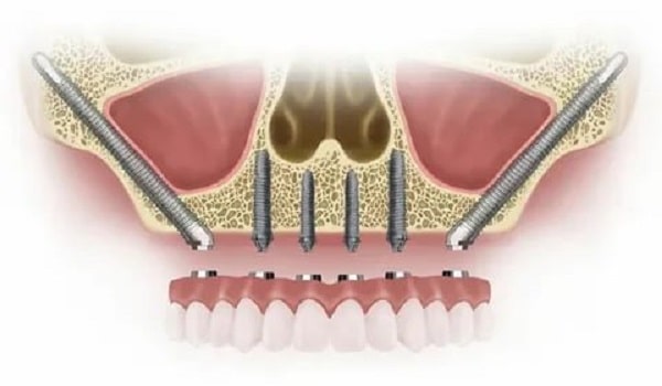یکی از روش های ایمپلنت دندان، ایمپلنت دندان زیگوماتیک است