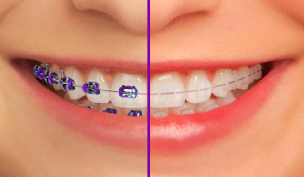 ارتودنسی بهتر است یا لمینت,ارتودنسی بهتره یا کامپوزیت,ارتودنسی دندان