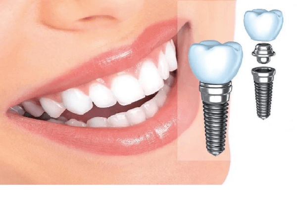 طول عمر ایمپلنت دندان در صورت انجام مراقبت های لازم،حداقل 20 سال است