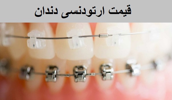 قیمت ارتودنسی دندان