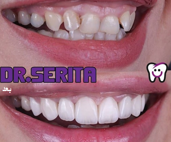 تاثیر لمینت دندان در اصلاح ظاهر دندان های نا مرتب