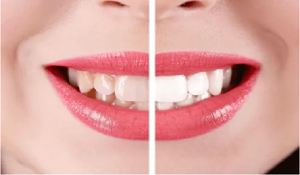 لمینت کامپوزیتی از انواع لمینت دندان است