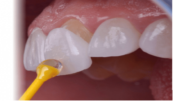 کاربرد لمینت سرامیکی دندان