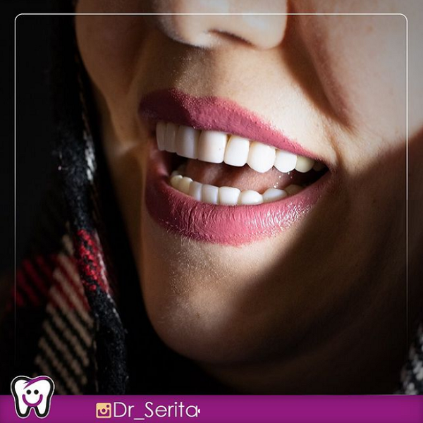 ایمپلنت بهتر است یا کامپوزیت,تغییر رنگ دندان,درمان فاصله بین دندان
