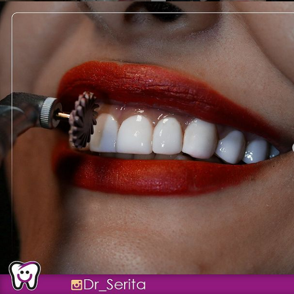 رفع سیاهی دندان,فرق لمینت و کامپوزیت دندان,نمونه کار های کلینیک دندانپزشکی دکتر سریتا